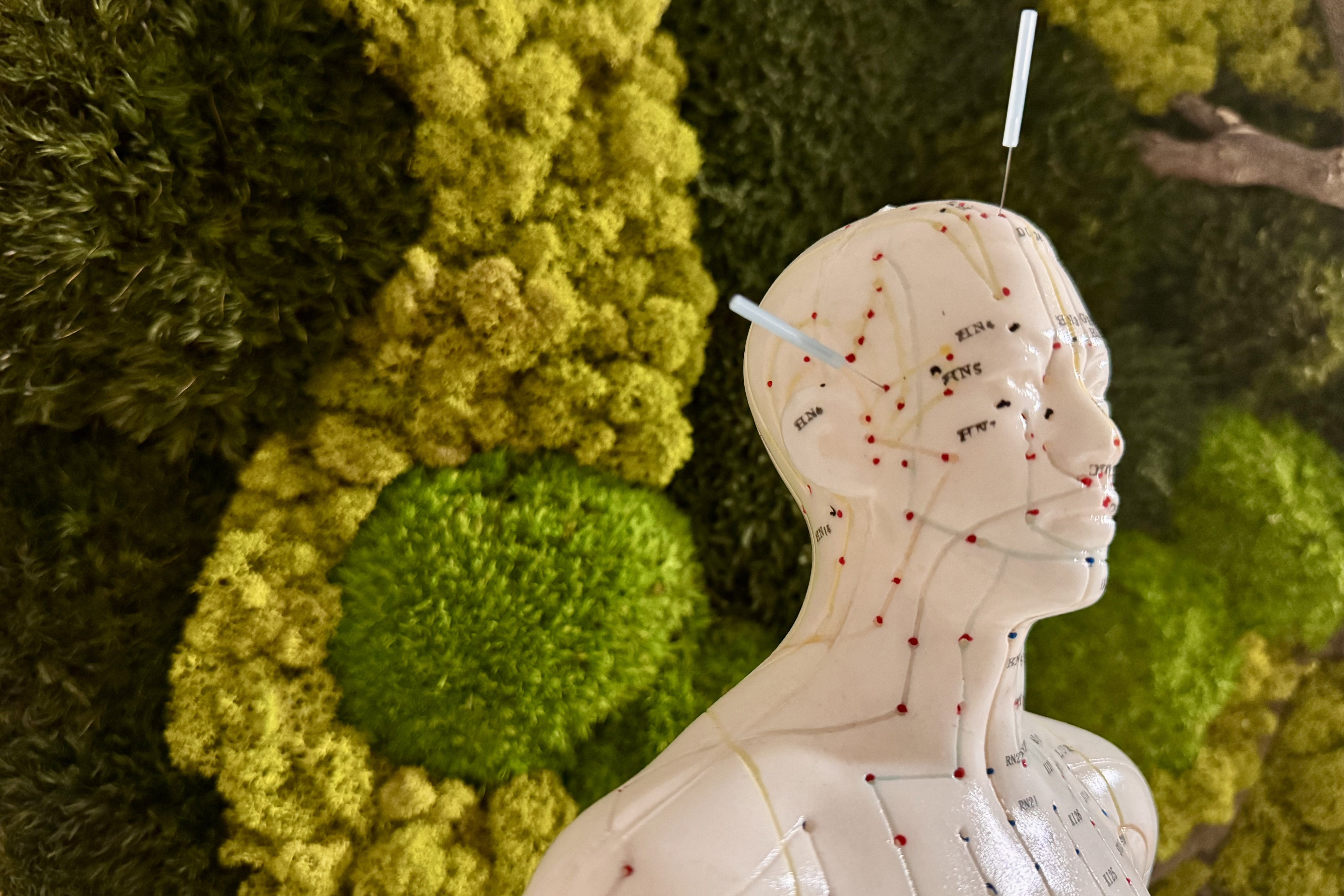 Schädelakupunktur (YNSA)